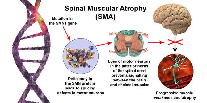 Spinal Muscle Atrophy