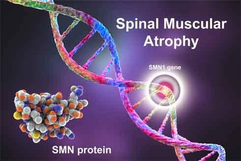 Symptoms of Spinal Muscle Atrophy